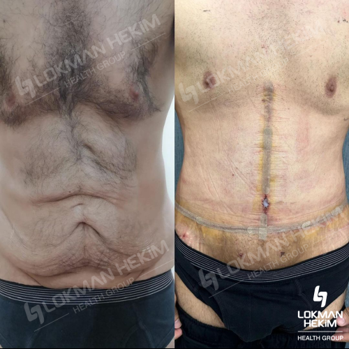 J plasma Renuvion Before / After photo